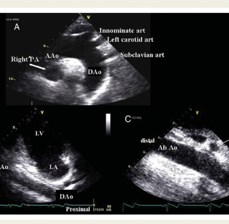 Echographie Doppler Des Troncs Supra Aortiques Etsa Cardiologue